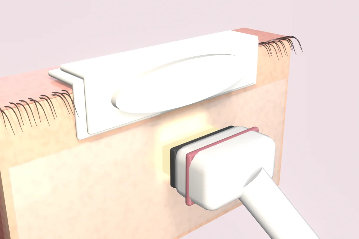 Light handpiece held just off gel-covered skin below the lower lashes, with gauze and an opaque patch covering the lid margin