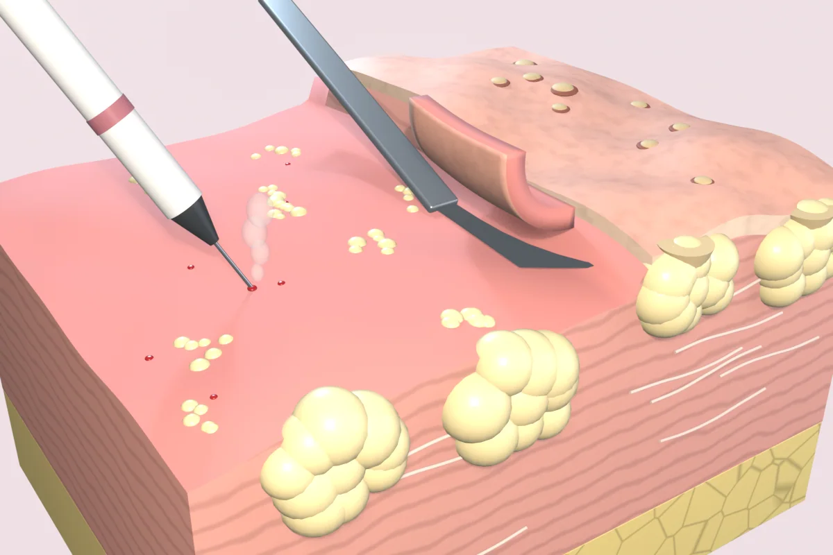 Blade lifting a thin layer off thickened skin while a needle-tip electrode touches a bleeding point on a bed studded with yellow-white oil-gland lobules