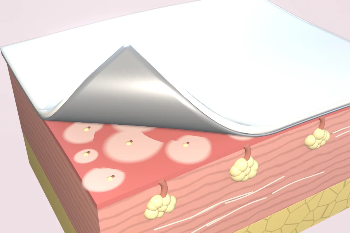 Silver dressing, gauze and clear film peeled back from a smoothed wound, where pale new skin spreads around the remaining gland and follicle openings