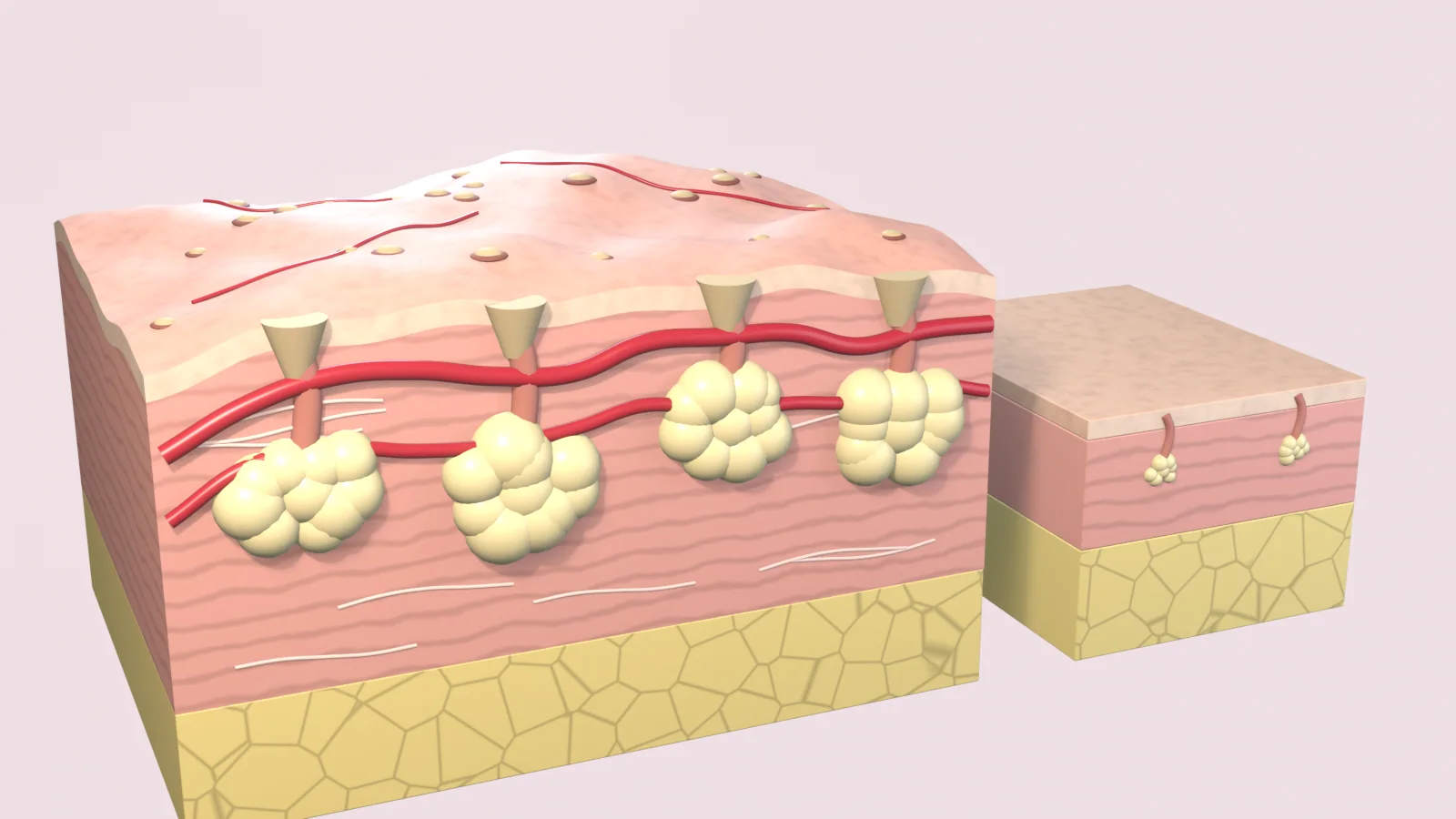 Thickened skin block with a lumpy surface, enlarged oil glands, keratin-plugged follicle openings and widened vessels, beside a thinner block of normal skin